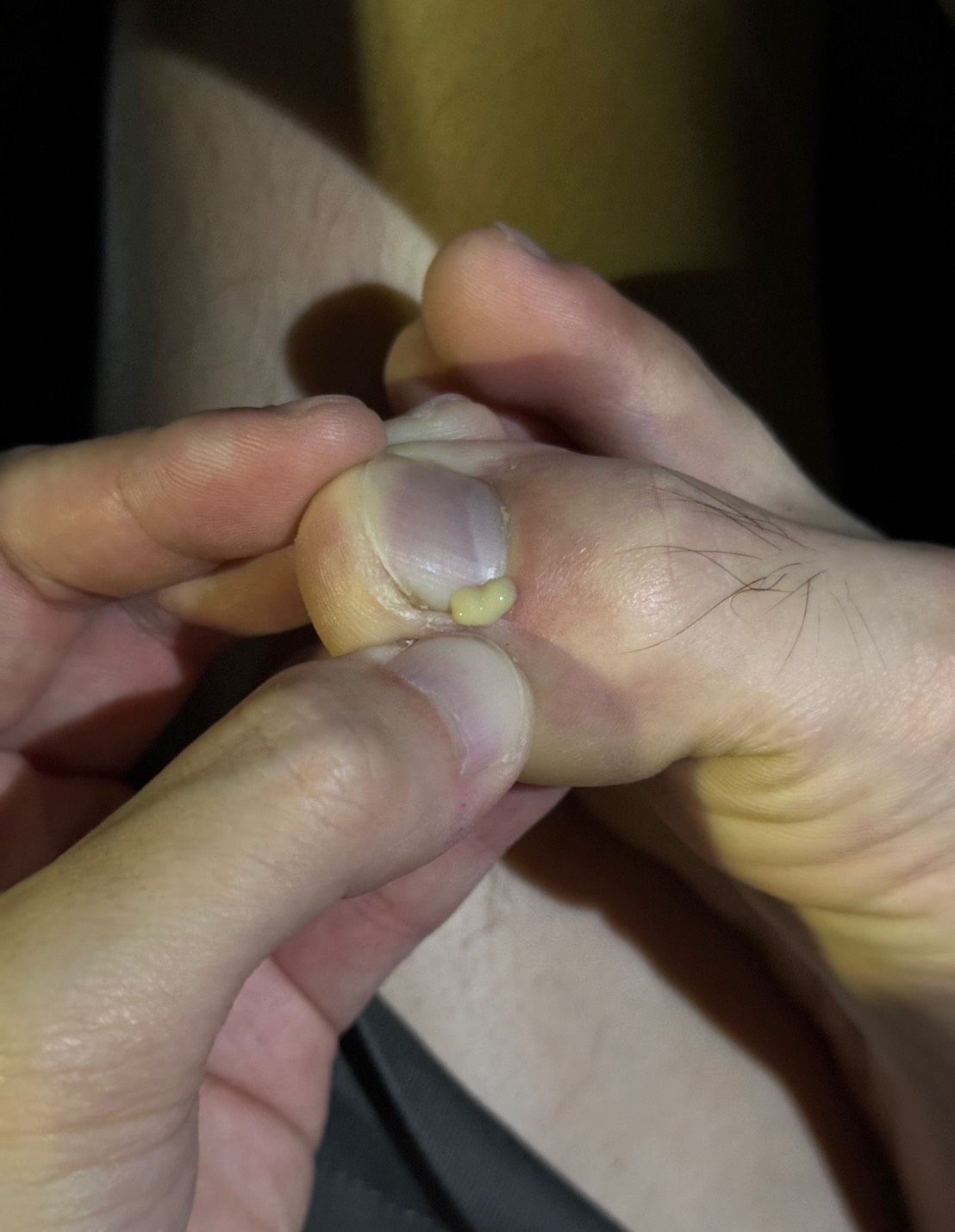 thumb