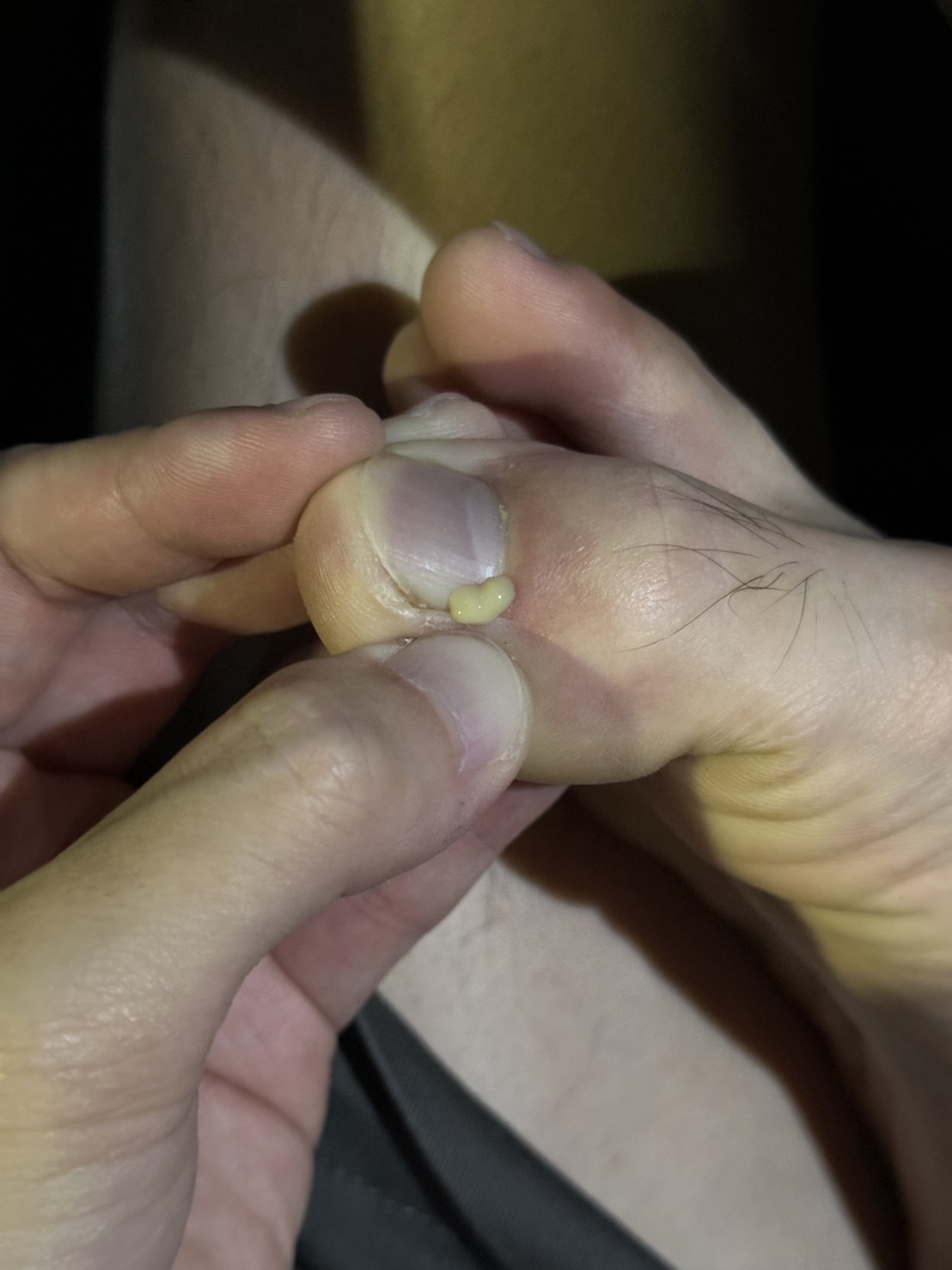 thumb